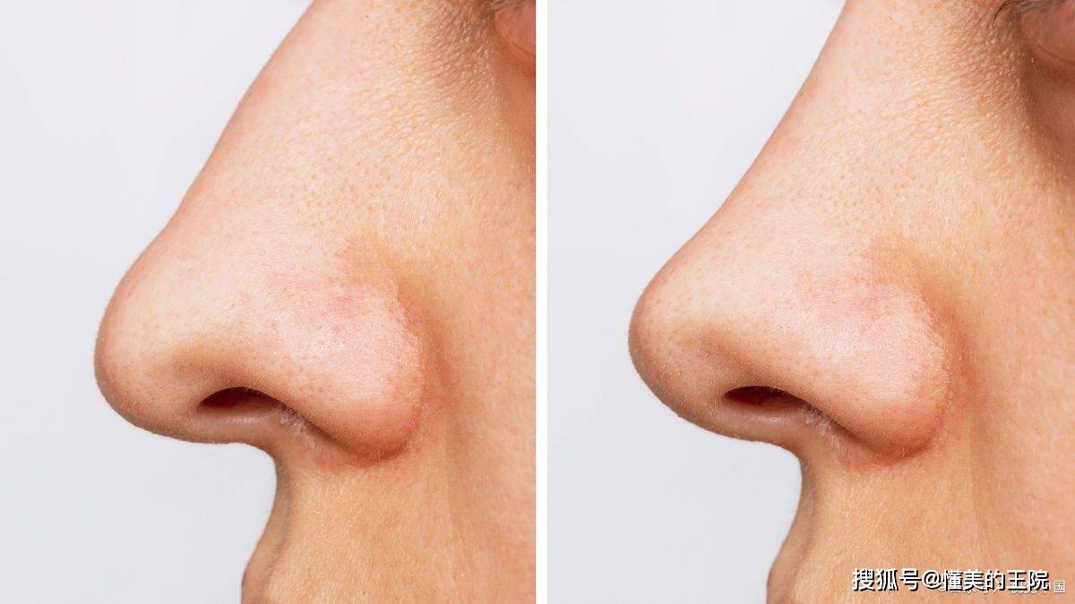 肋软骨鼻整形：全方位打造完美鼻型
